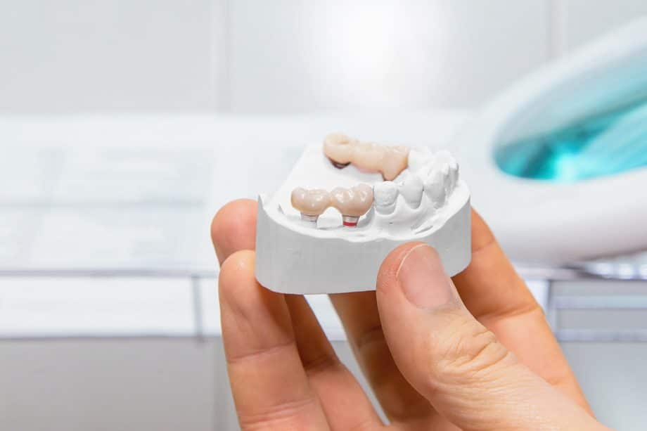 How Much Do Dental Bridges Cost in Sun City Center, FL