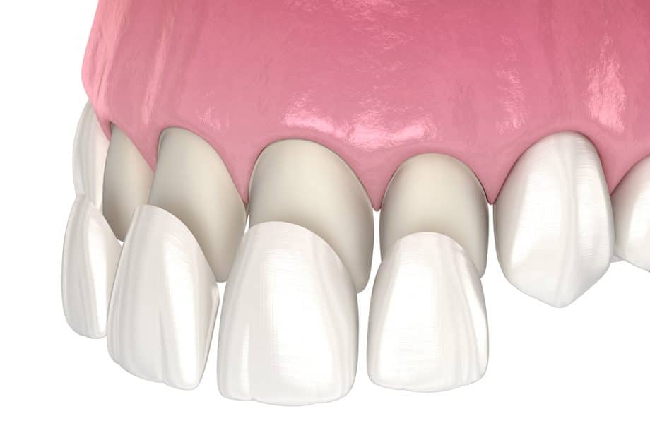 Are Dental Veneers Worth It?