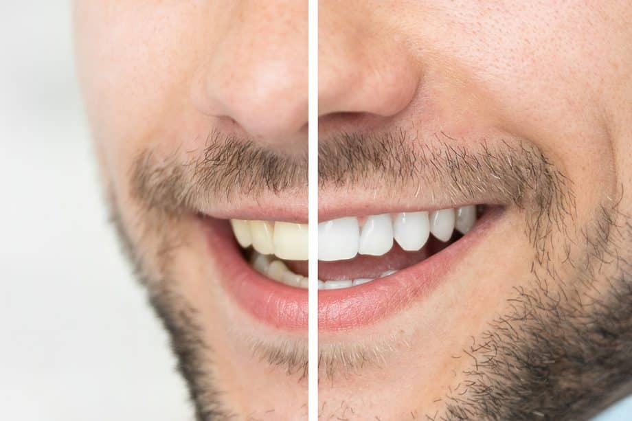 Benefits of In-Office Teeth Whitening