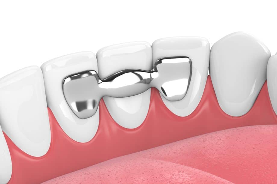 How Long Do Dental Bridges Last?