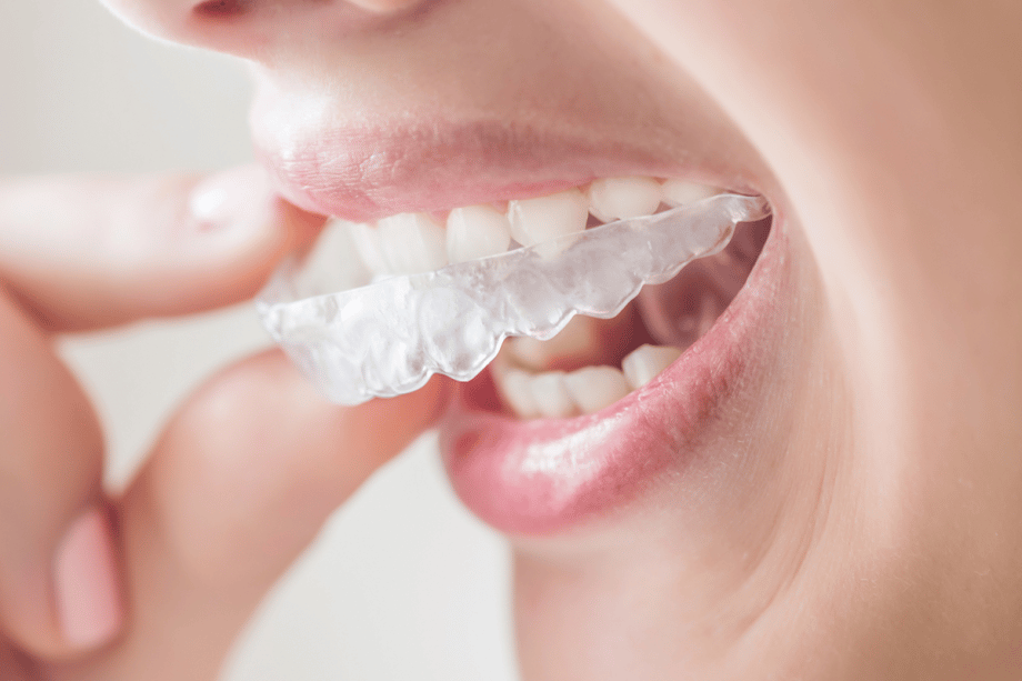 How Much Does Invisalign Cost in Sun City Center?