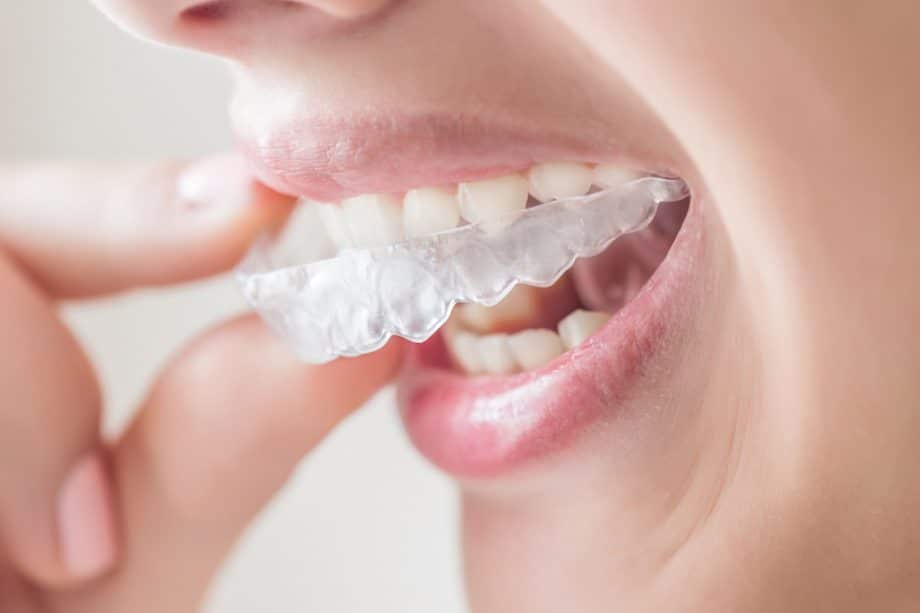 Invisalign: A Clear Path to a Straighter Smile