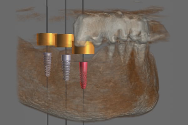 Full Arch with Only Four Implants graphic