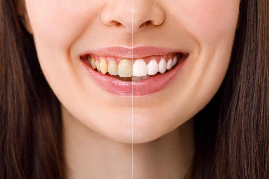 Teeth Whitening vs. Veneers: Which Improves Your Smile Faster?