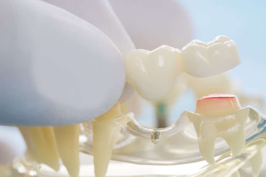 What to Expect After a Dental Bridge Procedure